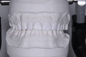 mock up facettes dentaires