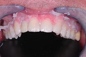 mock up facettes dentaires