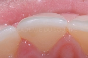 éclaircissement interne dent