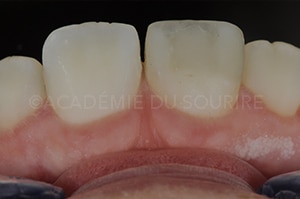 polissage de composites dentaires