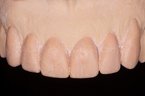 renforcer dents temporaires
