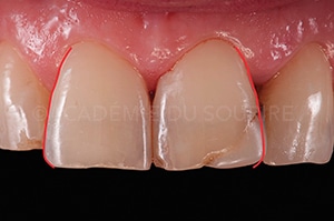 Face proximale stratification