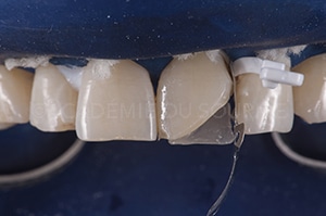 Face proximale stratification