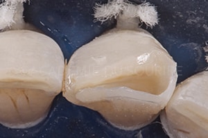 Face proximale stratification