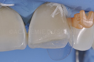 Face proximale stratification
