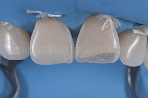 Face proximale stratification