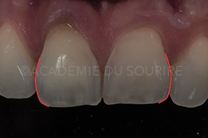 Face proximale stratification