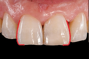 Face proximale stratification