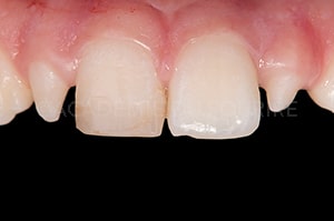 relevé de couleur dentaire technique bouton