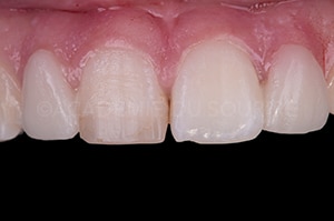 relevé de couleur dentaire technique bouton