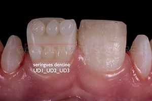 relevé de couleur dentaire technique bouton