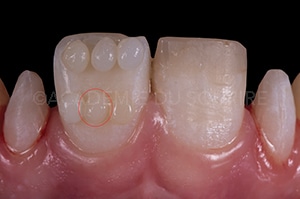 relevé de couleur dentaire technique bouton