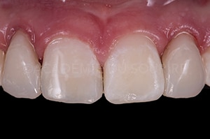 relevé de couleur dentaire technique bouton