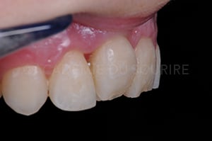 Finition composite