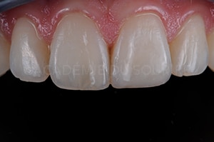 Finition composite