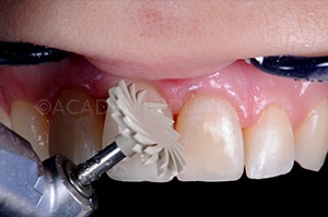 Finition composite