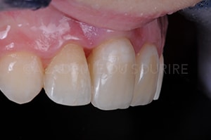 Finition composite