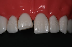 clé palatine silicone composite antérieur