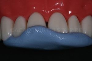 clé palatine silicone composite antérieur