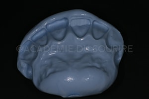 clé palatine silicone composite antérieur