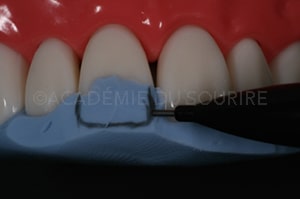 clé palatine silicone composite antérieur