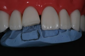 clé palatine silicone composite antérieur