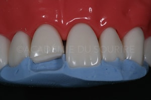 clé palatine silicone composite antérieur