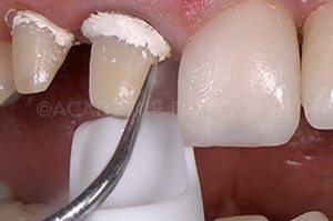 empreinte dentaire expasyl