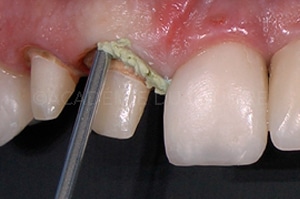 empreinte dentaire expasyl