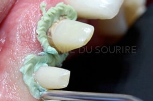 empreinte dentaire expasyl