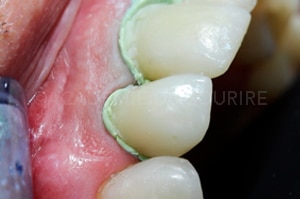 empreinte dentaire expasyl