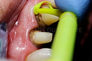 empreinte dentaire expasyl
