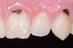 Acces soins sous gingivaux demi clamp