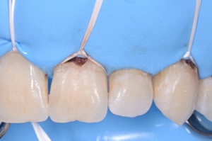 Acces soins sous gingivaux demi clamp