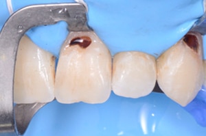 Acces soins sous gingivaux demi clamp