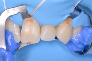 Acces soins sous gingivaux demi clamp