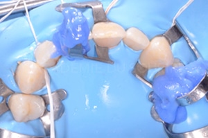 Acces soins sous gingivaux demi clamp