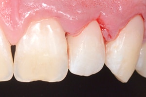 Acces soins sous gingivaux demi clamp