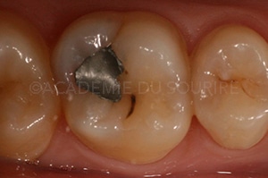 Point de contact dentaire