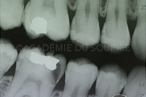 Point de contact dentaire