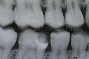 Point de contact dentaire