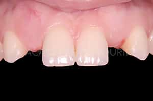 Gestion mucco gingivale intermediaire bridge