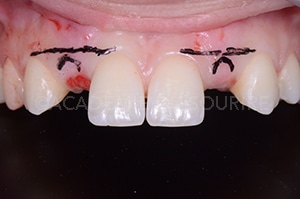 Gestion mucco gingivale intermediaire bridge