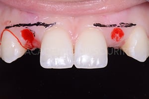 Gestion mucco gingivale intermediaire bridge