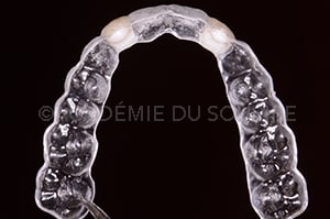 Gestion mucco gingivale intermediaire bridge
