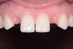 Gestion mucco gingivale intermediaire bridge