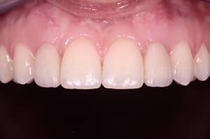 Gestion mucco gingivale intermediaire bridge