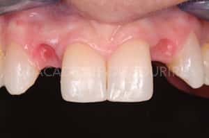 Gestion mucco gingivale intermediaire bridge
