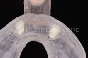 Gestion mucco gingivale intermediaire bridge