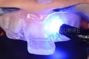 Gestion mucco gingivale intermediaire bridge